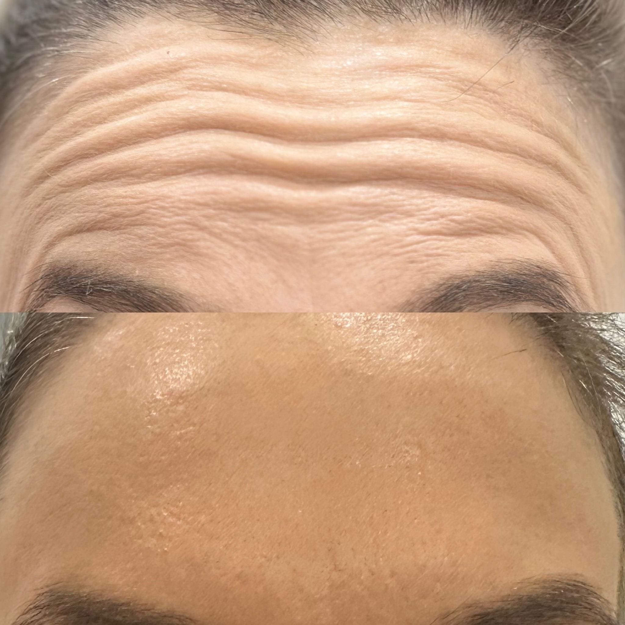 Anti-wrinkle treatment to FRONTALIS muscle (forehead lines)