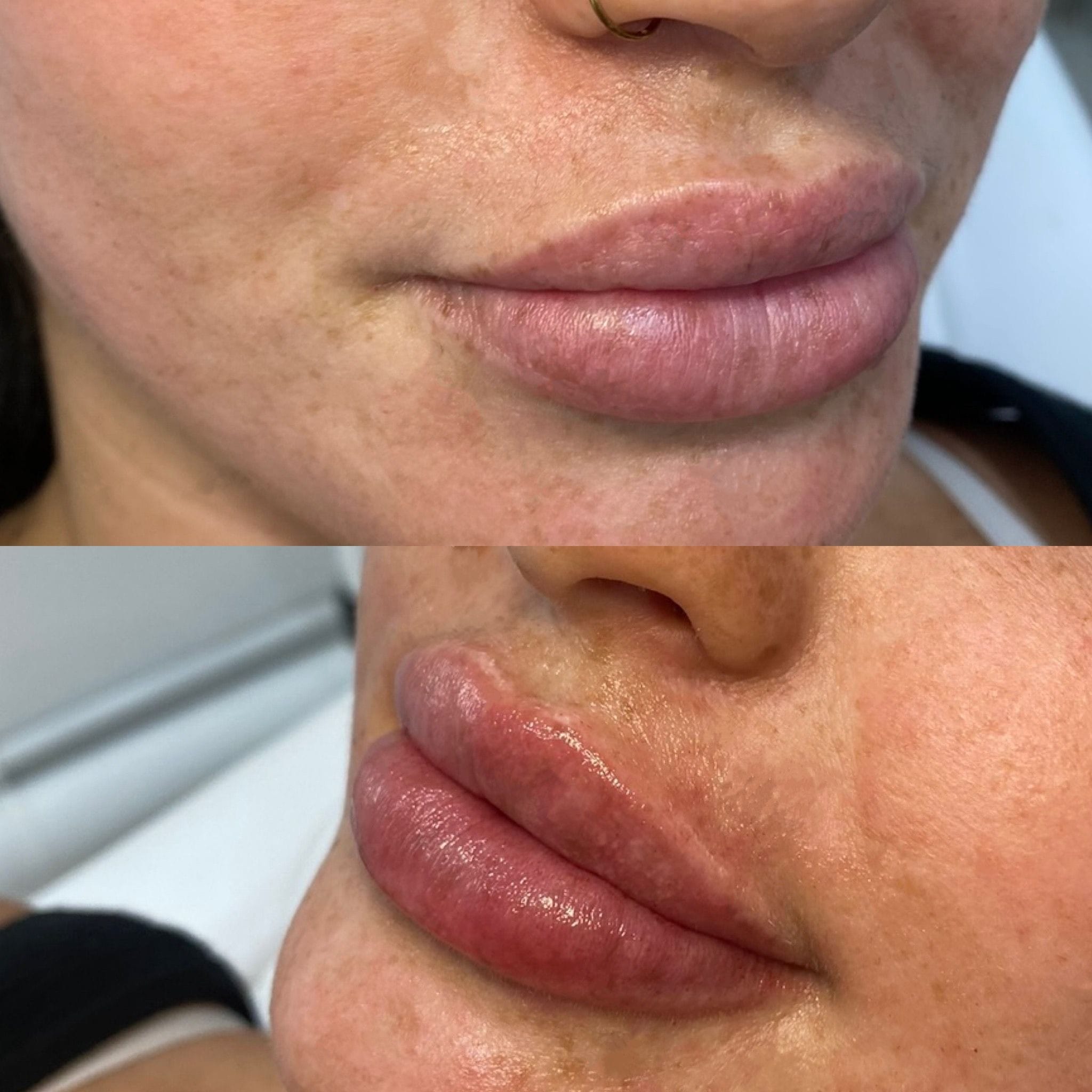 Dermal filler to the lips to create shape, definition and hydration