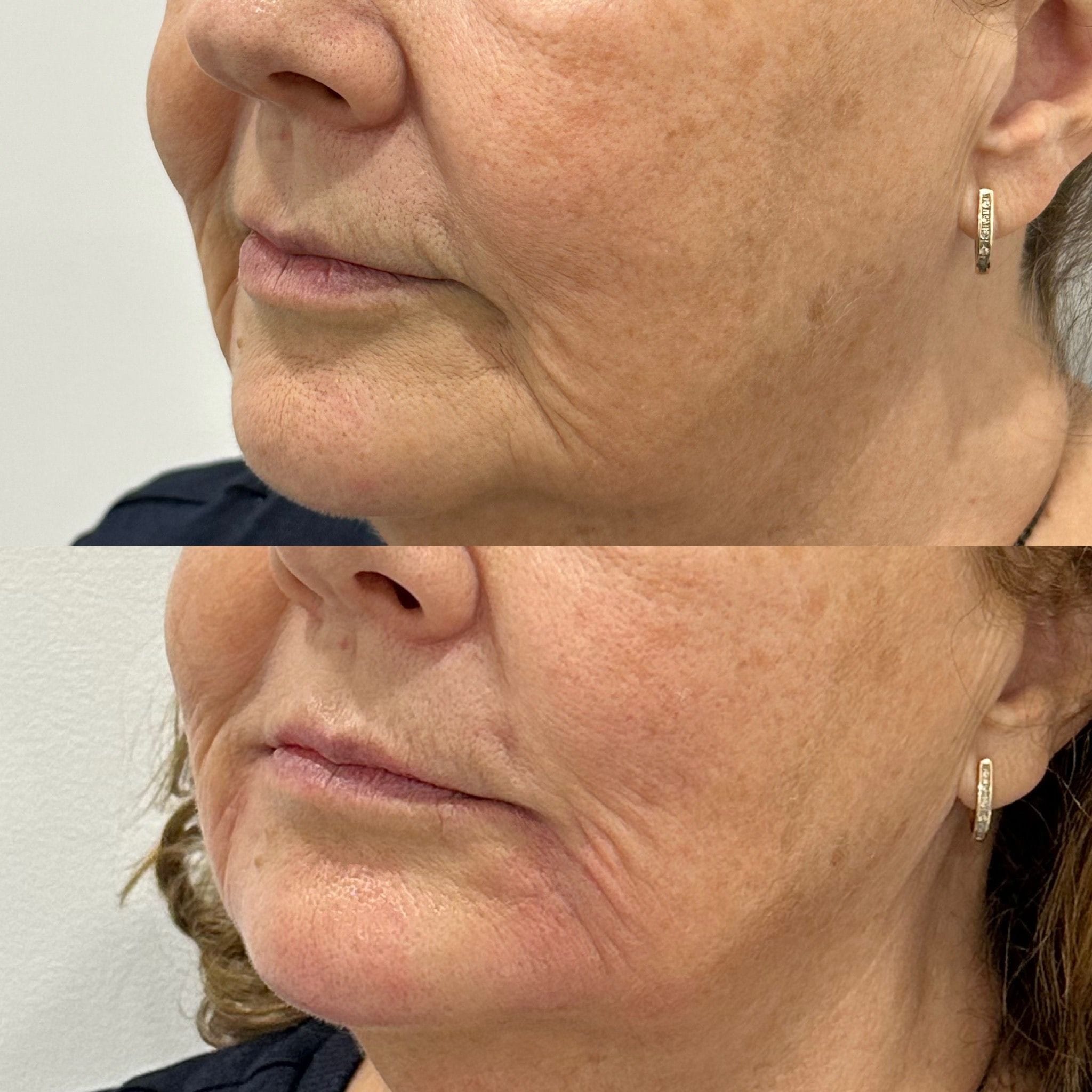 Dermal filler to the pre-jowl sulcus to restore shape and definition the the jawline and lower face rejuvination