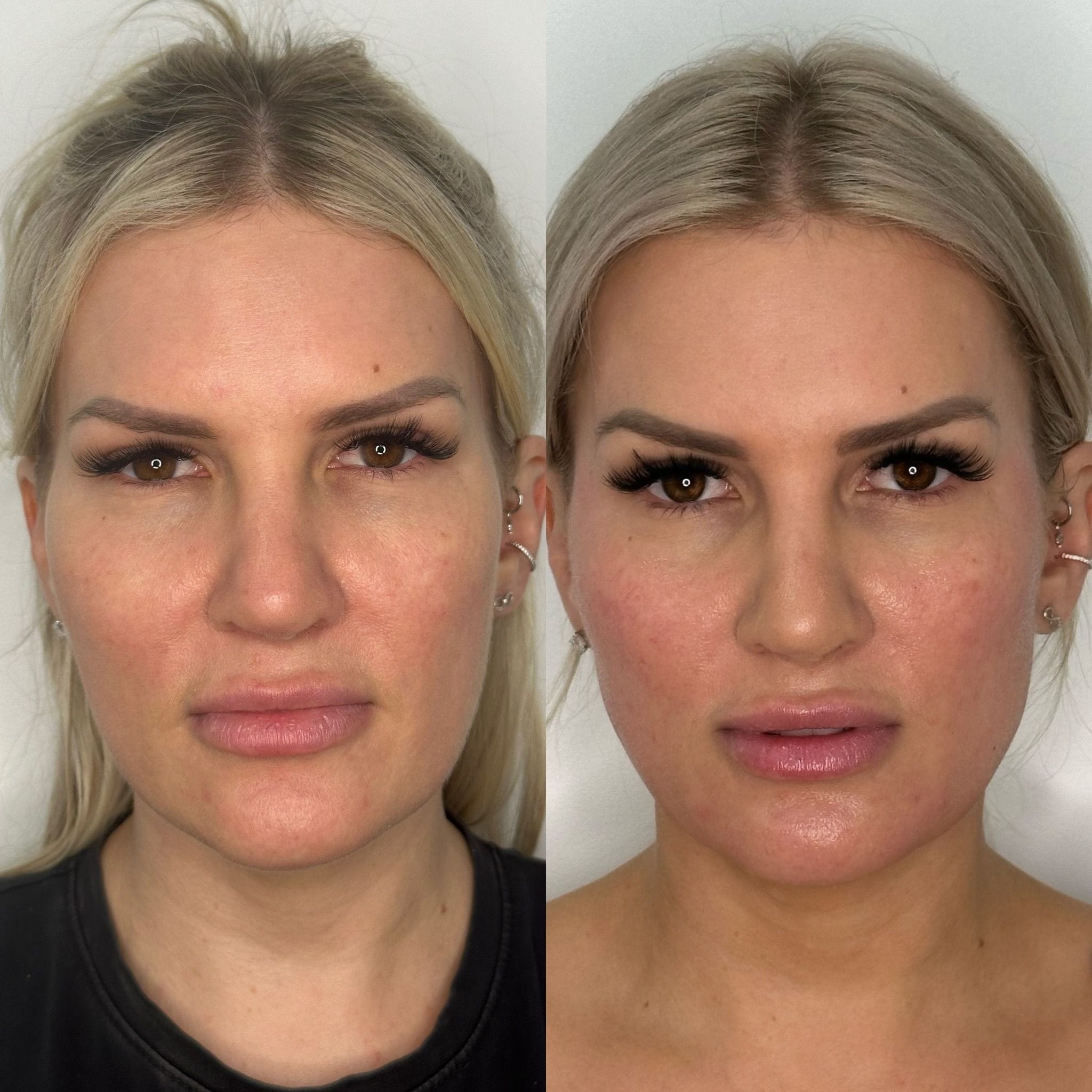 Collagen stimulating treatement to the temples, cheeks, pre-auricular and pre-jowl sulcus. Creates natural collagen production for 25+ months.