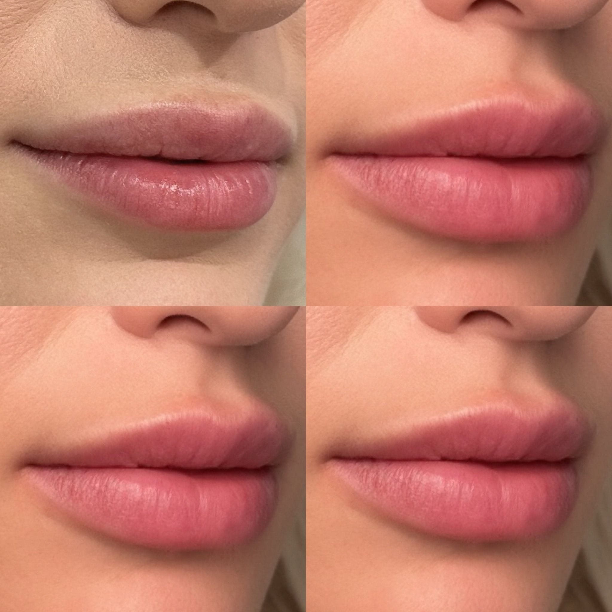 Dermal filler to the lips to create shape, definition and hydration