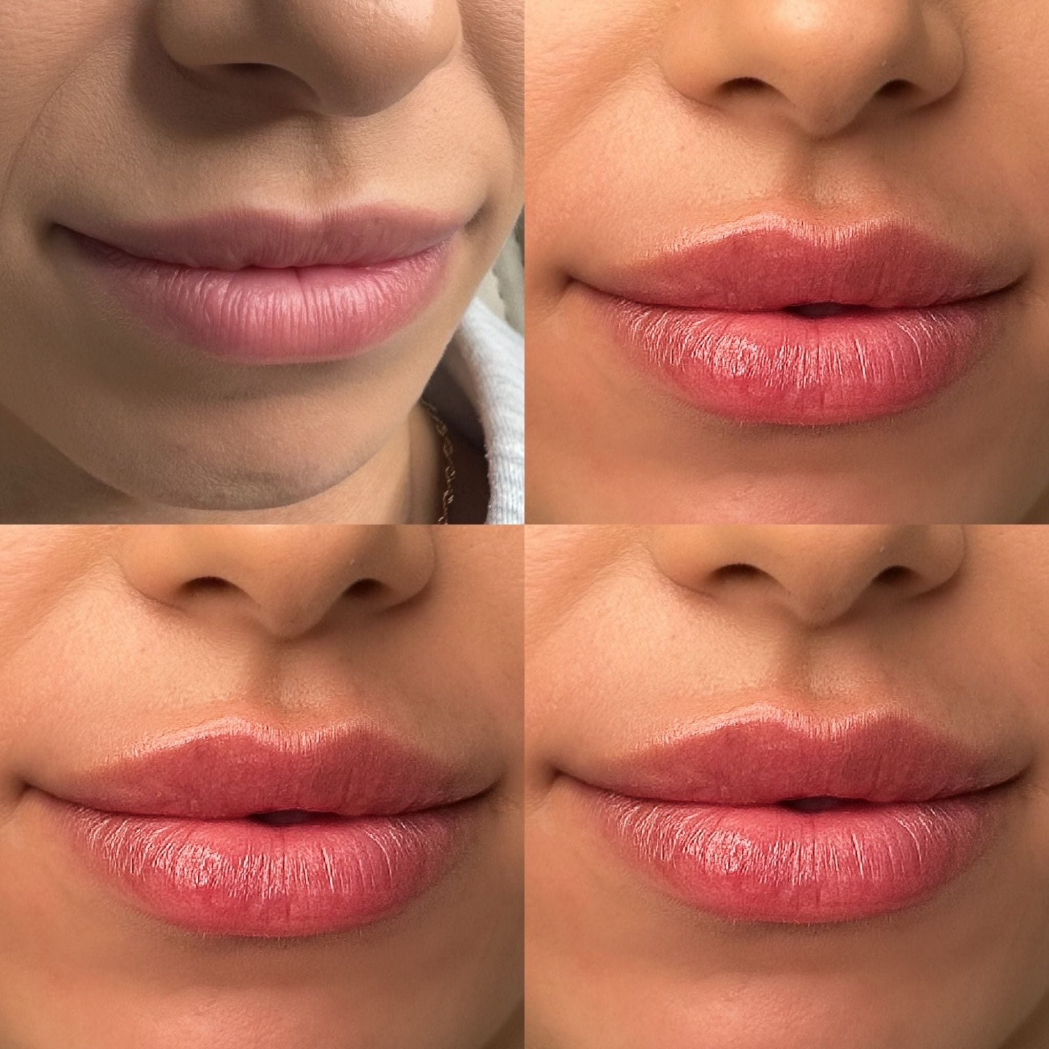 Dermal filler to the lips to create shape, definition and hydration