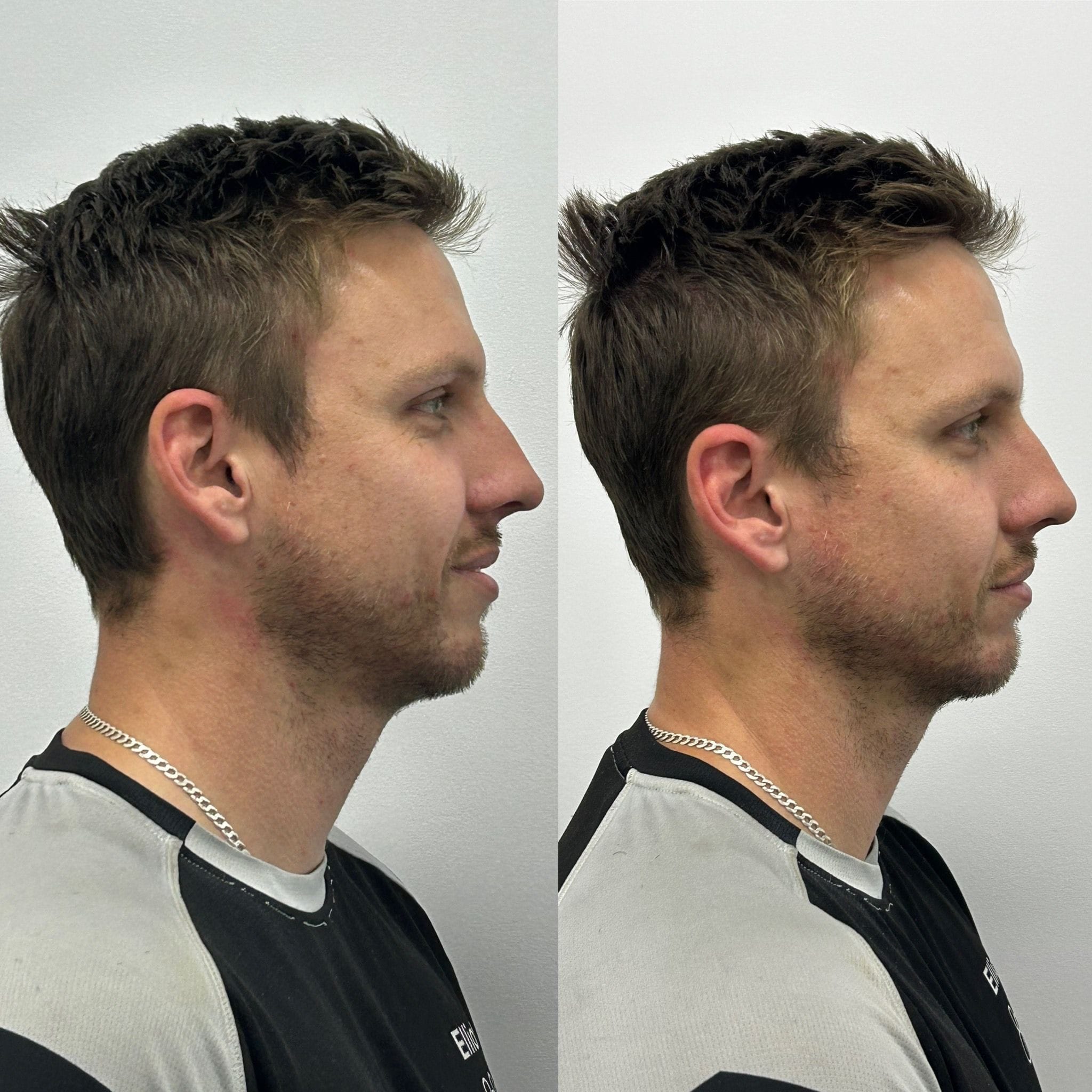 Dermal filler to the jawline to create contour, definition and masculine angle