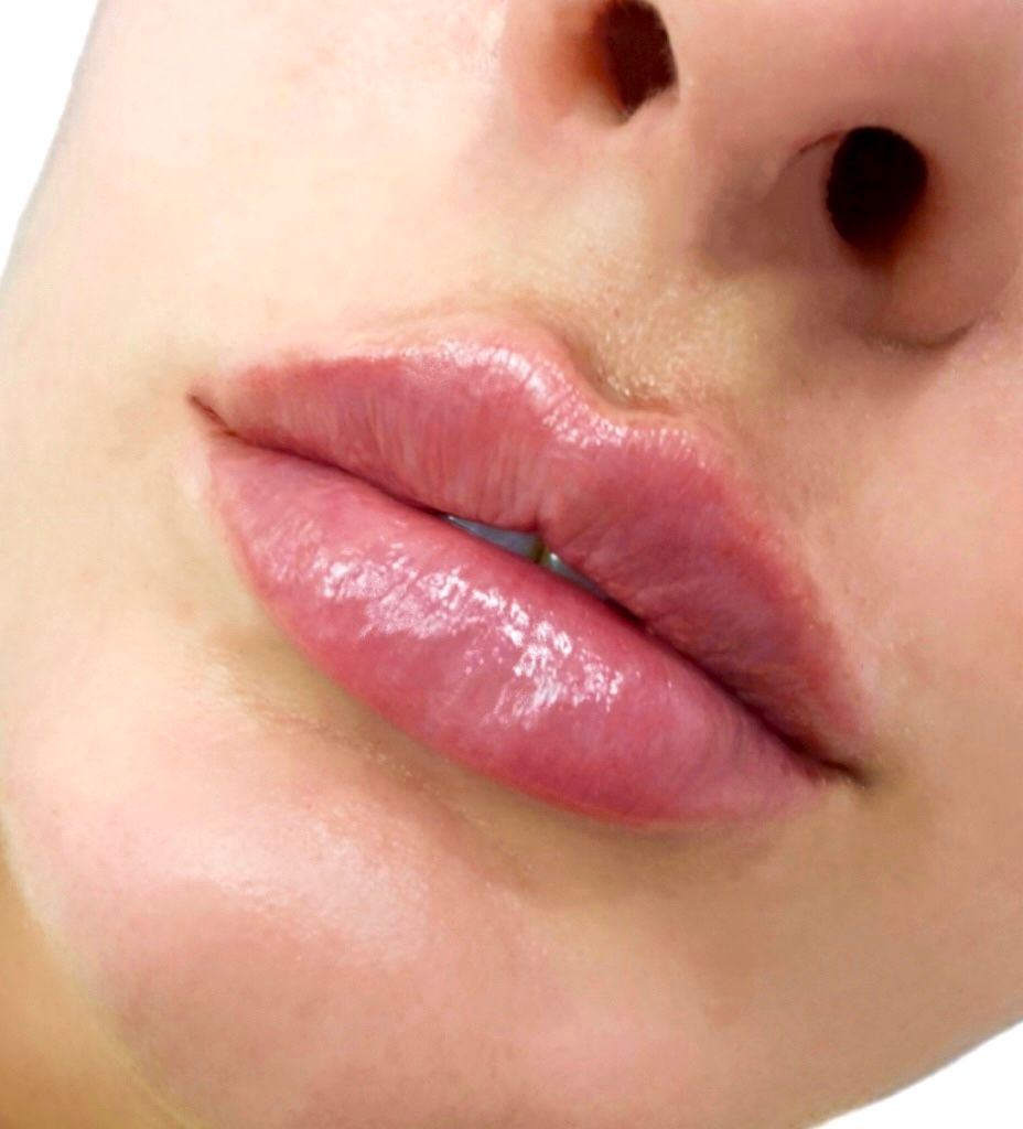 Dermal filler to the lips to create shape, definition and hydration