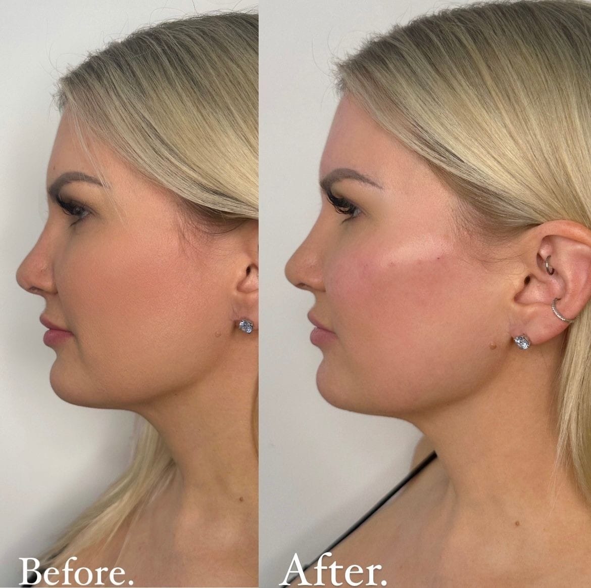 Dermal filler to the cheek to add definition and contour