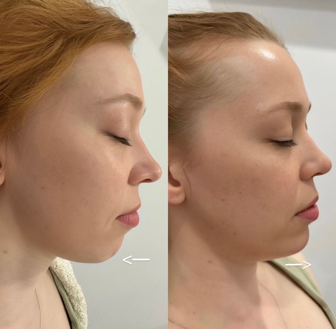 Dermal filler to the chin to create facial harmony and balance