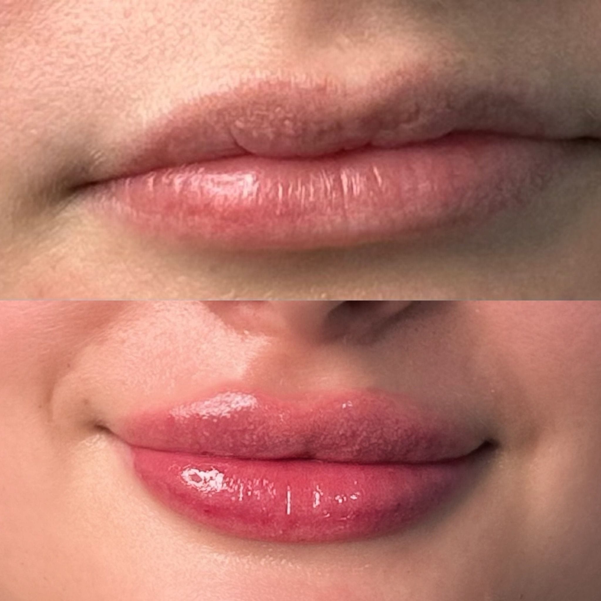 Dermal filler to the lips to create shape, definition and hydration. Lip correction.