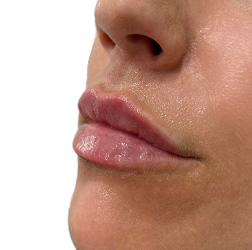 Dermal filler to the lips to create shape, definition and hydration