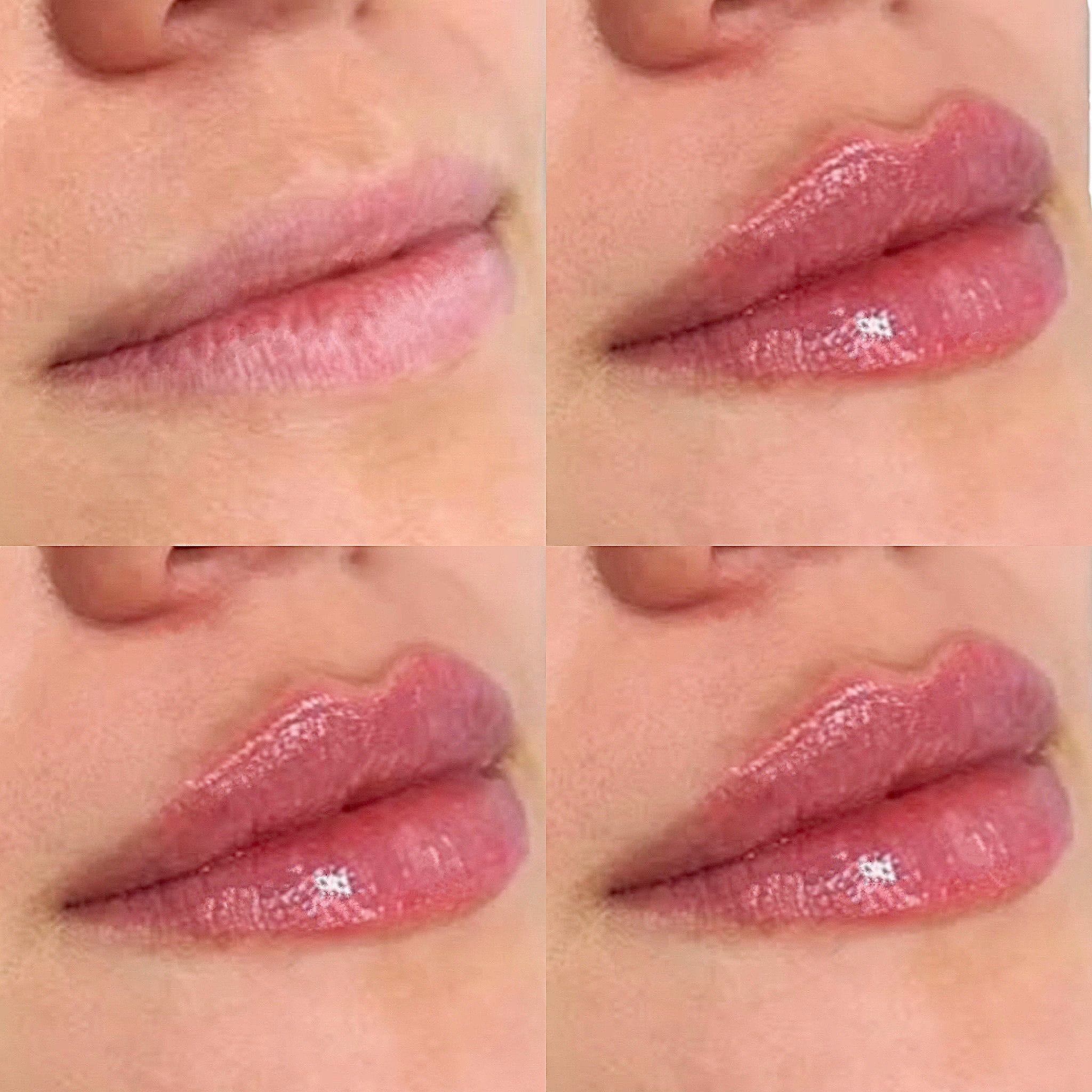 Dermal filler to the lips to create shape, definition and hydration