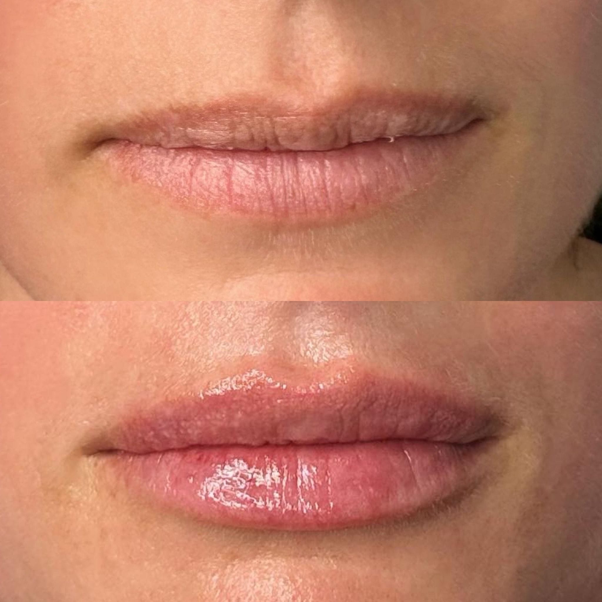 Dermal filler to the lips to create shape, definition and hydration