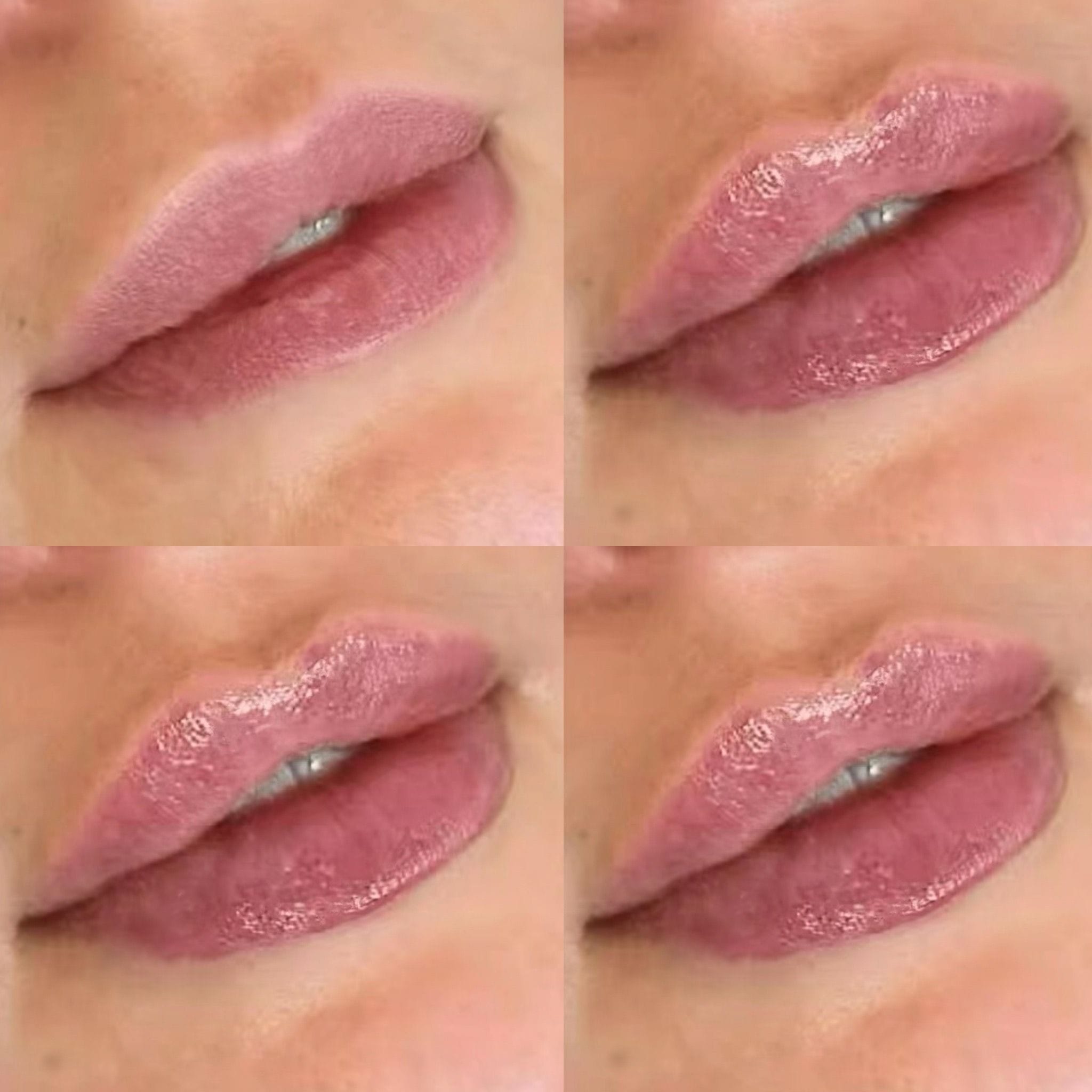 Dermal filler to the lips to create shape, definition and hydration